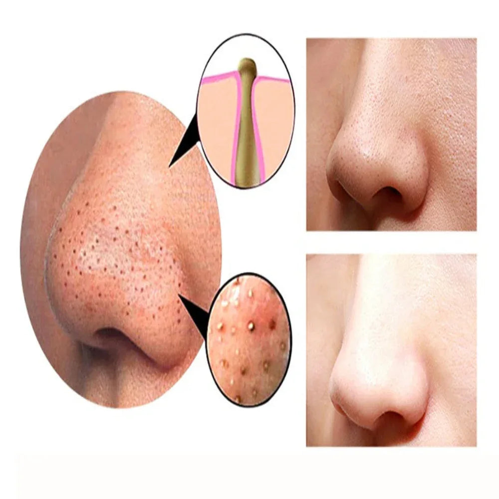 Blackhead Remover Machine Facial Pore Deep Cleansing Beauty Skin Care