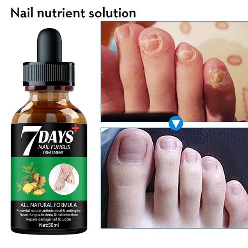 Sérum pour le traitement des mycoses des ongles des pieds