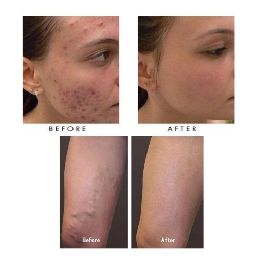 Stylo de luminothérapie bleue